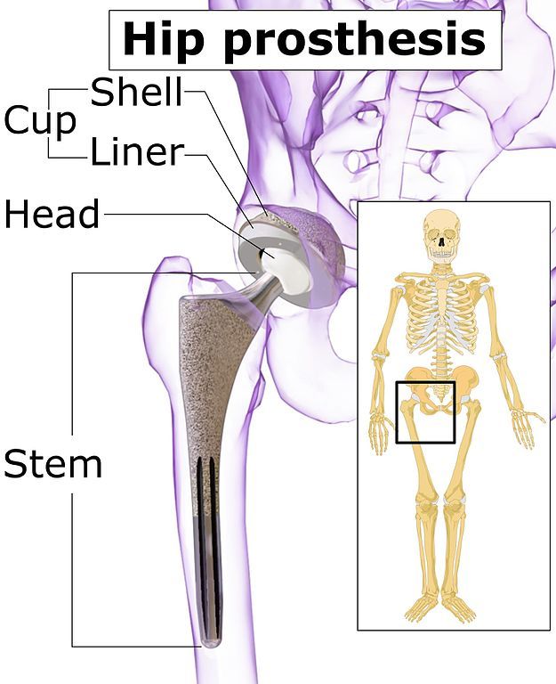 Hip_prosthesis_components 1