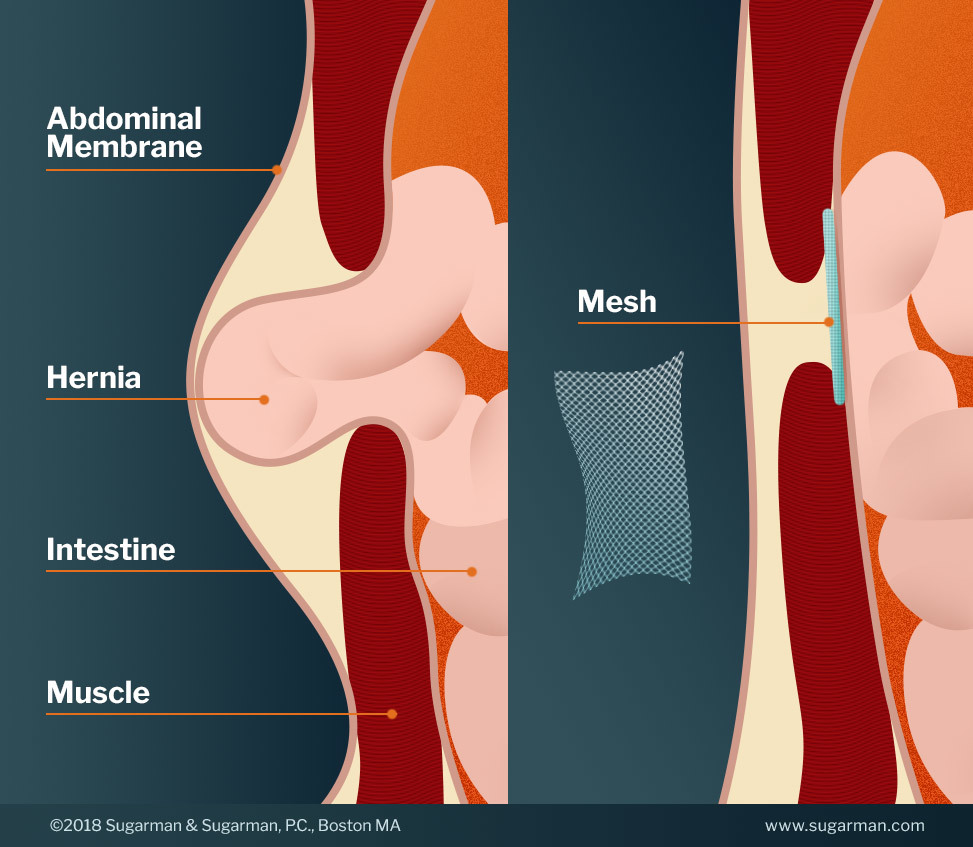 hernia mesh illustration