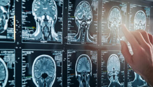 MRI of Brain 